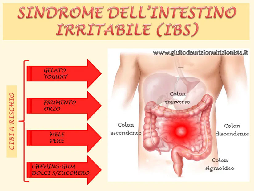sindrome-intestino-irritabile